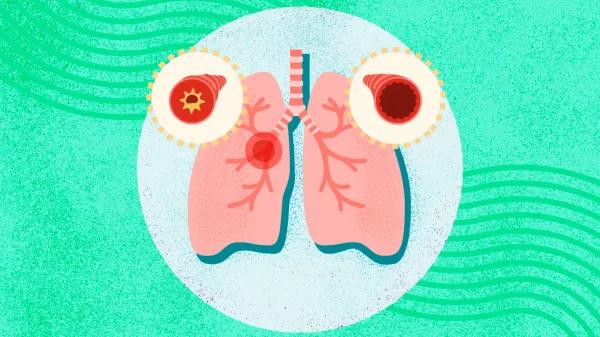 Cannabinoide sintético reduce inflamación asmática en ratones
