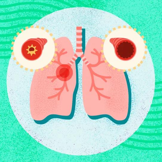 Cannabinoide sintético reduce inflamación asmática en ratones