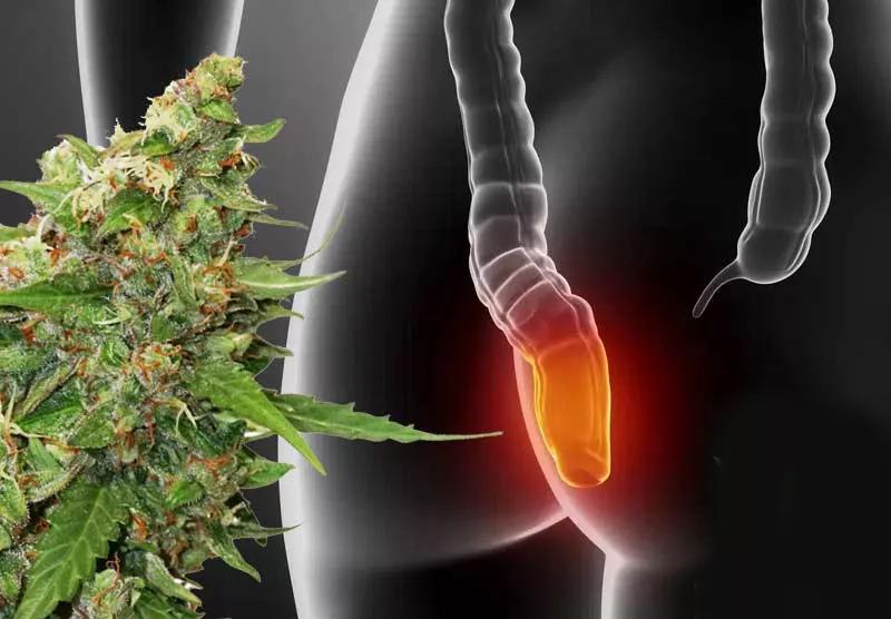 Cannabis y cáncer de colón