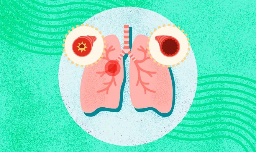 Cannabinoide sintético reduce inflamación asmática en ratones