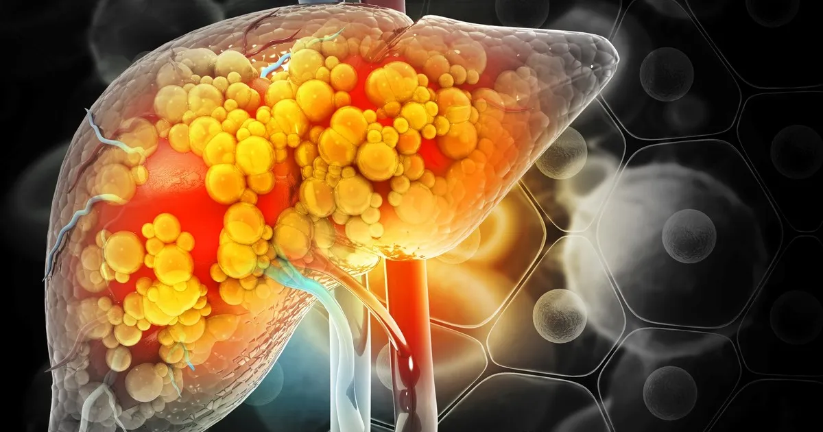 Alcohol Consumption Becomes Critical Factor in Fatty Liver Disease Evaluation